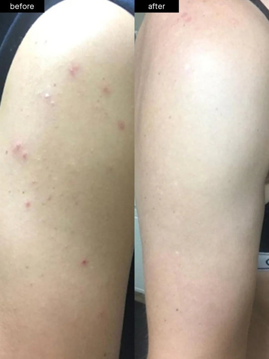 Benzoyl Peroxide Face & Body Wash: The Holy Grail for Acne