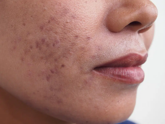 Pigmentation Around Mouth? Here’s What to Do Naturally