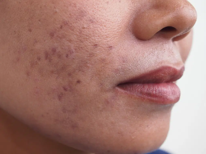 Best Ingredients for Fading Hyperpigmentation