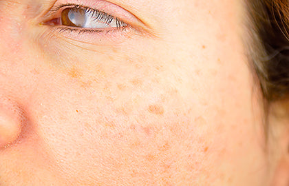 How to Get Rid of Old Age Spots Naturally: A Guide for Indian Skin