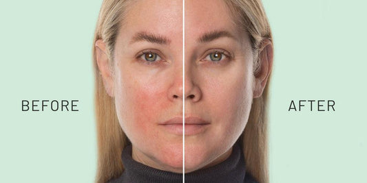 Skin Barrier Is Damaged? How to Repair It Fast (2026 Guide for Indian Skin)